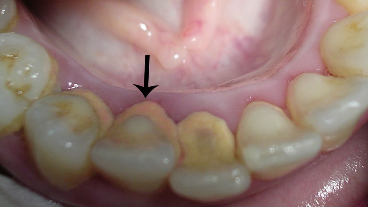 Tartrul subgingival